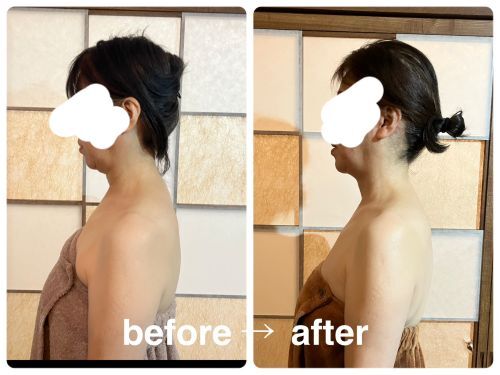 小松市、ドライヘッドスパ,小顔,たるみ,ほうれい線,幹細胞,頭痛,眼精疲労,耳鳴り,首コリ 小松市、ドライヘッドスパ,小顔,たるみ,ほうれい線,幹細胞,頭痛,眼精疲労,耳鳴り,首コリ