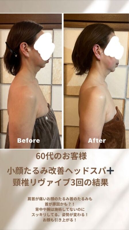 小松市、ドライヘッドスパ,小顔,たるみ,ほうれい線,幹細胞,頭痛,眼精疲労,耳鳴り,首コリ