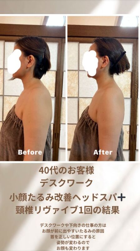 小松市、ドライヘッドスパ,小顔,たるみ,ほうれい線,幹細胞,頭痛,眼精疲労,耳鳴り,首コリ 小松市、ドライヘッドスパ,小顔,たるみ,ほうれい線,幹細胞,頭痛,眼精疲労,耳鳴り,首コリ